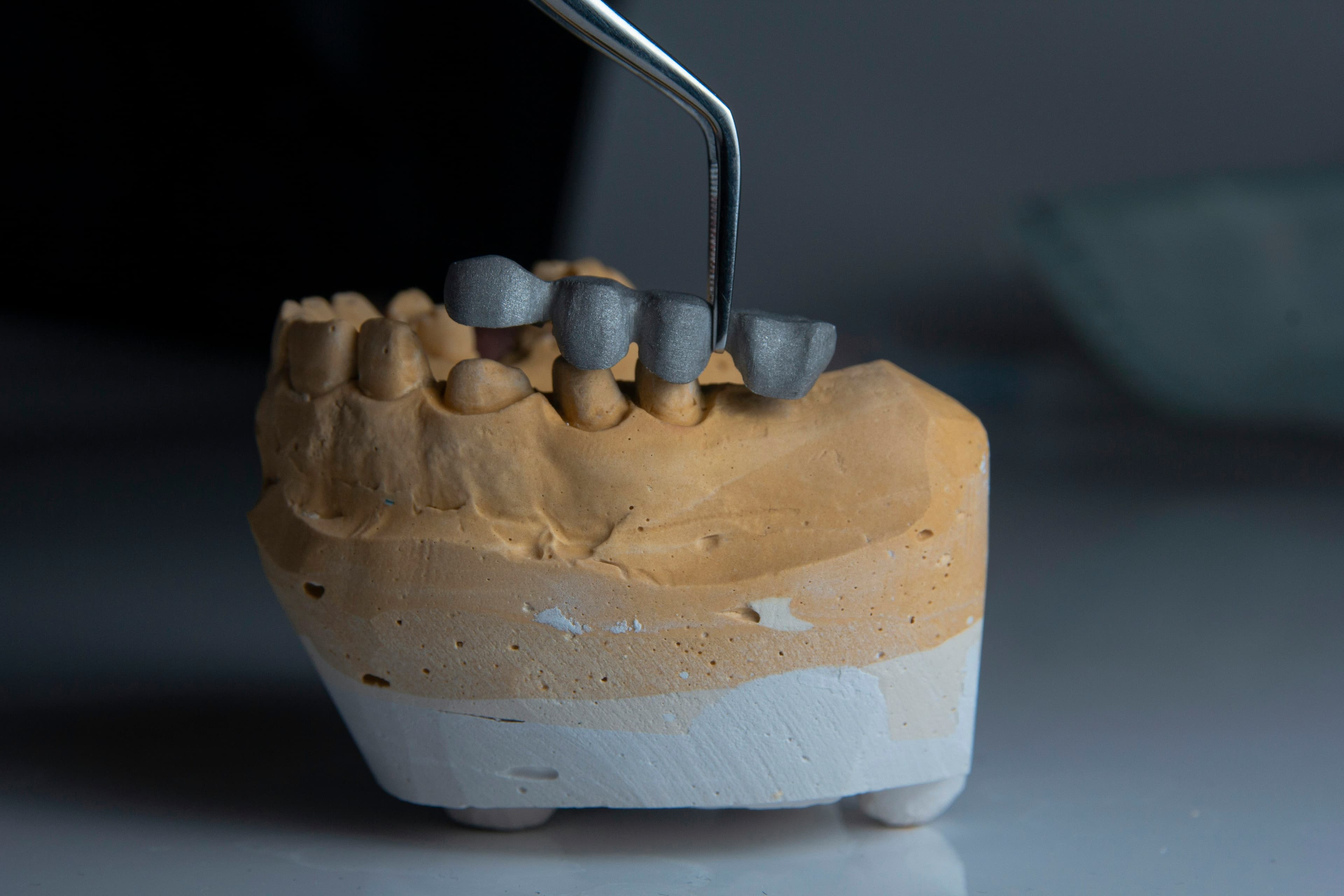 A dental model illustrating a restored tooth