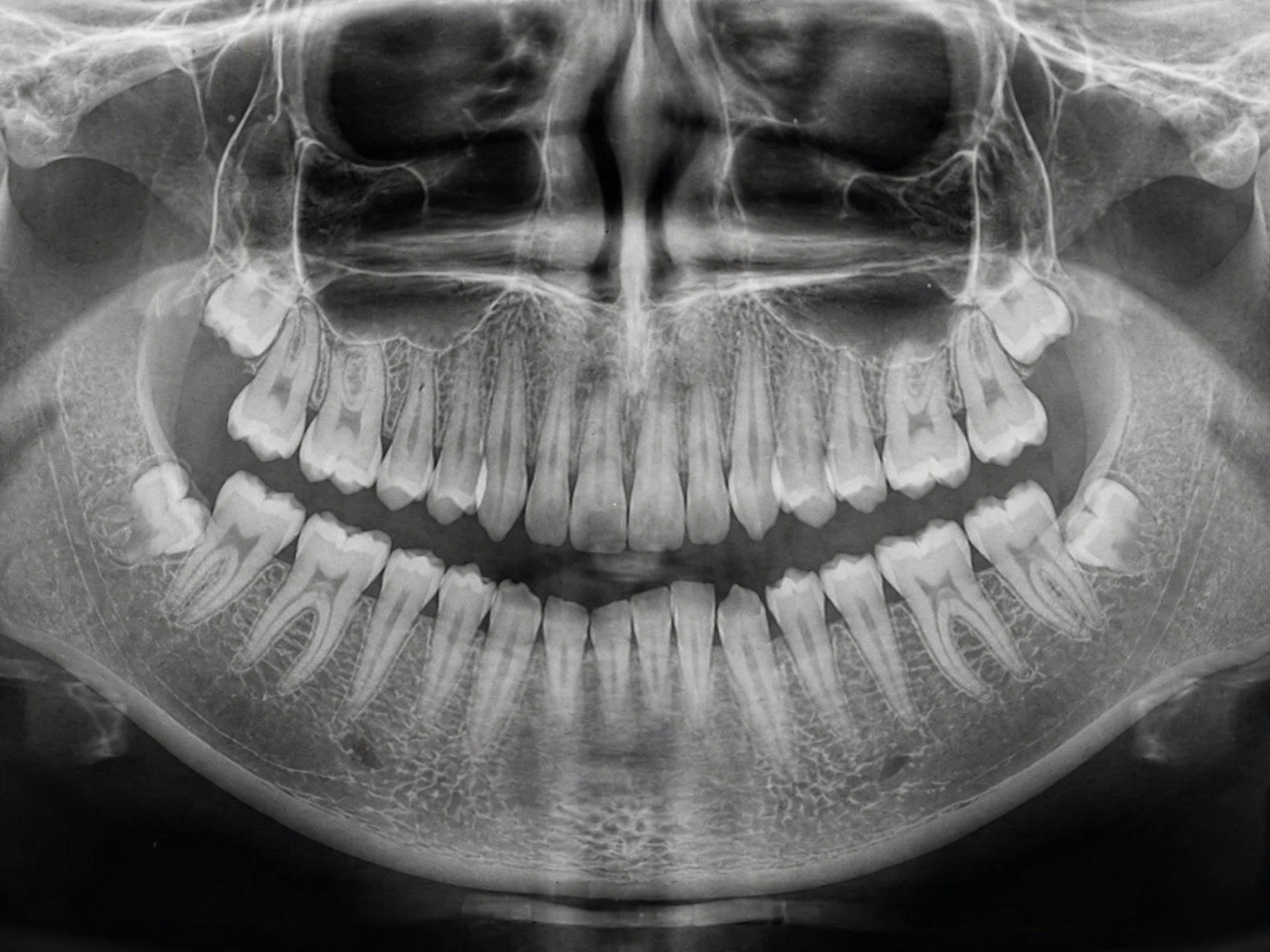 A panoramic dental X-ray used to plan root canal treatment