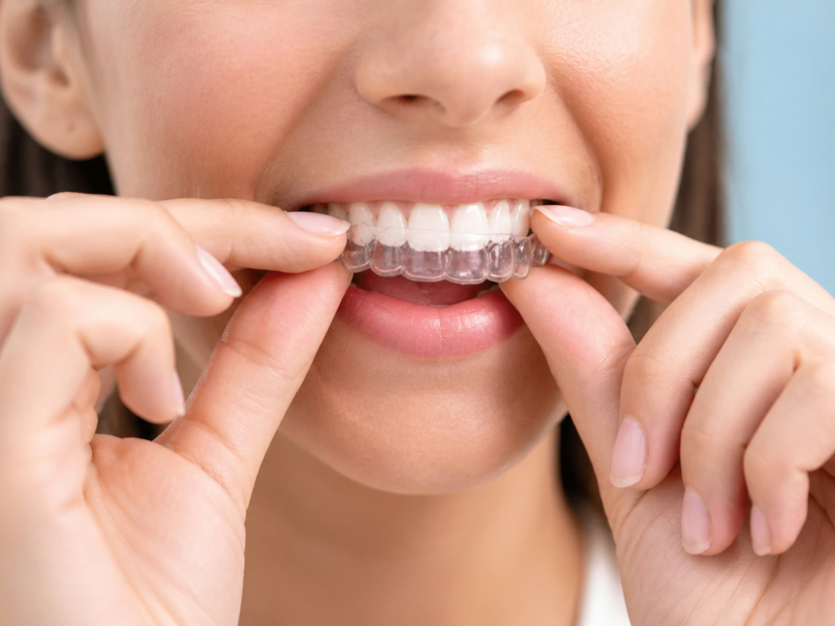 A close-up of a clear aligner tray being fitted onto teeth